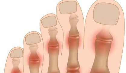 Артрит суставов пальцев ног