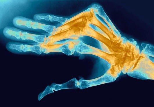 Пораженные артритом суставы на руках