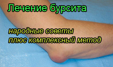 Бурсит коленного сустава лечение народными средствами форум thumbnail
