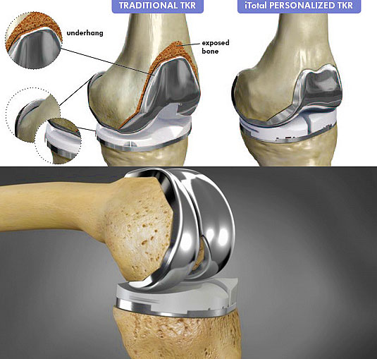 Тэп сустава. Эндопротез Зиммер коленного сустава е3. Тотальный эндопротез коленного сустава. Тотальное эндопротезирование коленного сустава. Эндопротезирование связок коленного сустава.